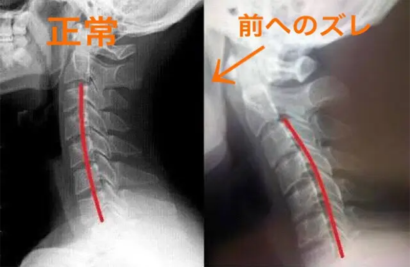 むち打ちのレントゲン写真
